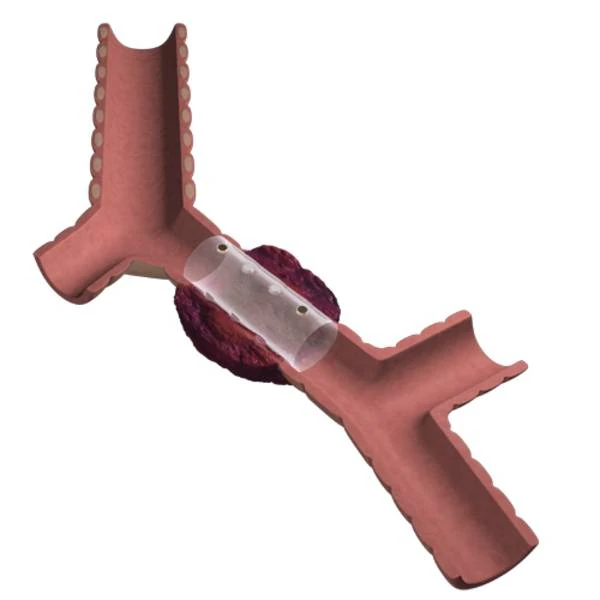 Novatech - Stent GSS BD in situ